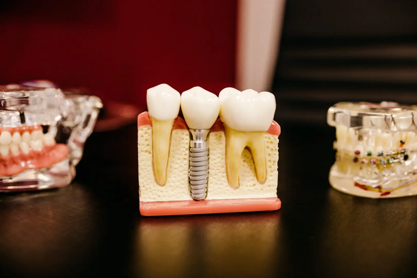 spa-3 Implantat